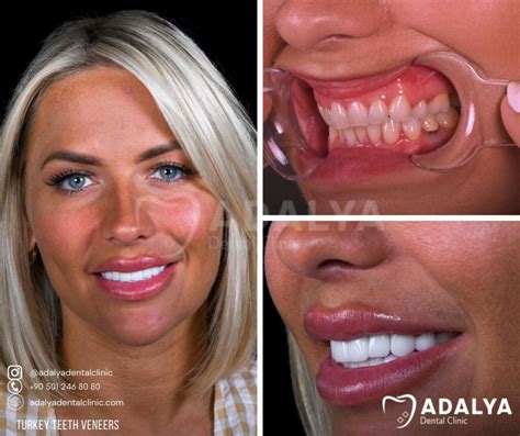 veneers in turkey reddit|Veneers in Turkey .